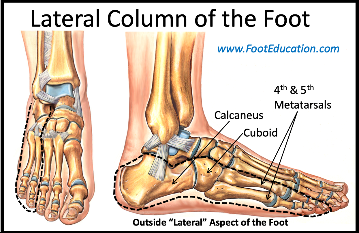 Lateral Column Lengthening - FootEducation