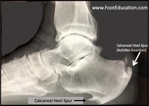 X-ray of a Calcaneal Bone Spurs at the Achilles insertion and near the Plantar Fascia origin