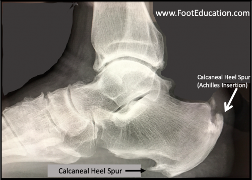 plantar and achilles calcaneal spurs