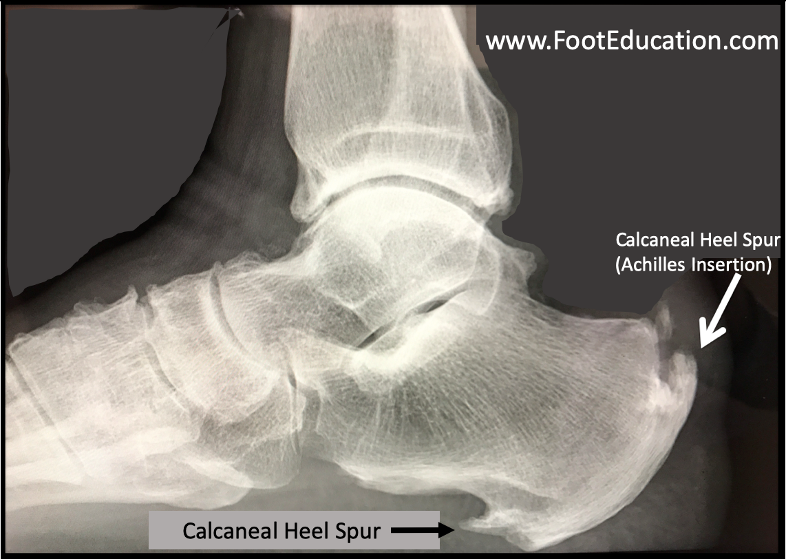 calcaneal traction spur