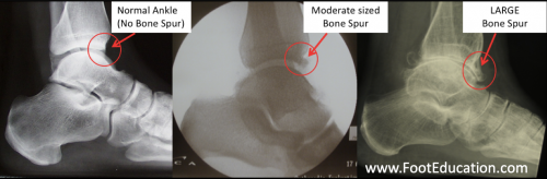 spurs x ray ankle