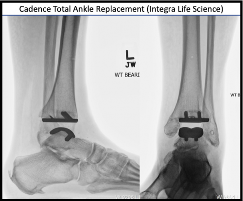 Total Ankle Replacement X-Ray
