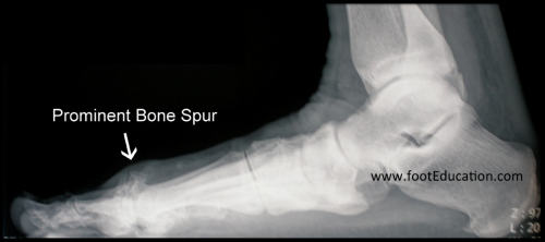 Bone Spurs - FootEducation