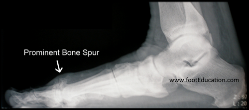 tarsal boss bone spur