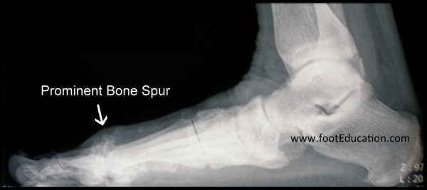Great Toe Bone Spur associated with Hallux Rigidus as seen on x-ray