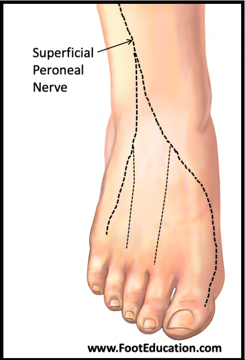Superficial Peroneal Neuritis Footeducation