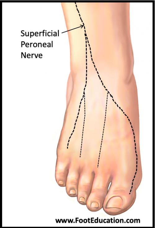 Superficial Peroneal Neuritis FootEducation