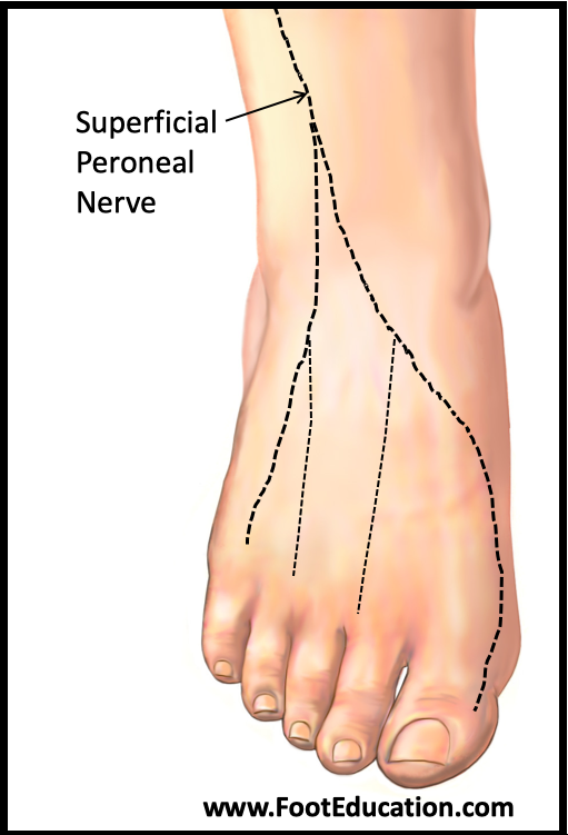 Superficial Peroneal Neuritis - FootEducation