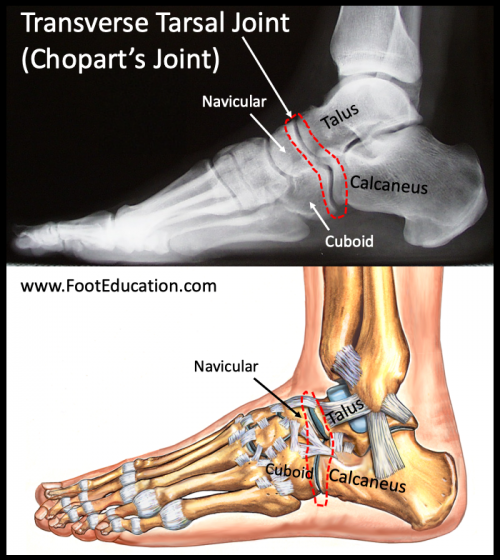 Medial Tarsal Bone Broken