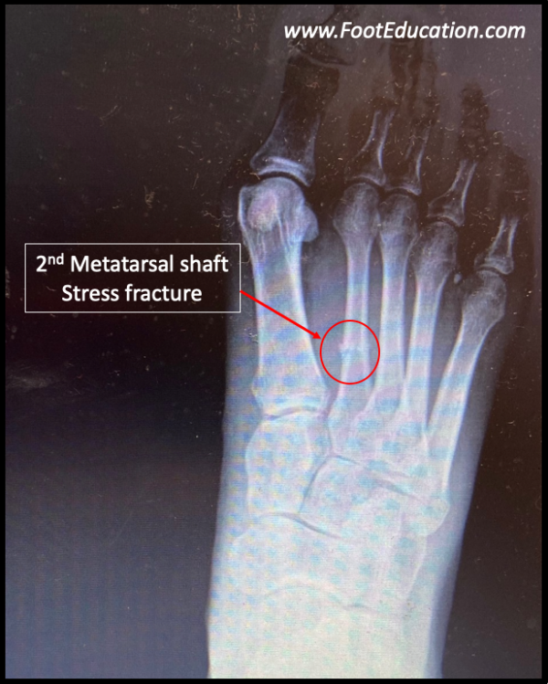 2nd Metatarsal Stress Fractures - FootEducation