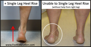 Single Leg heel rise test to assess for function of the posterior tibial tendon