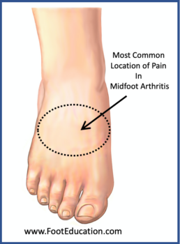 Location of pain in midfoot arthritis
