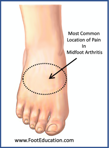 Midfoot Arthritis - FootEducation