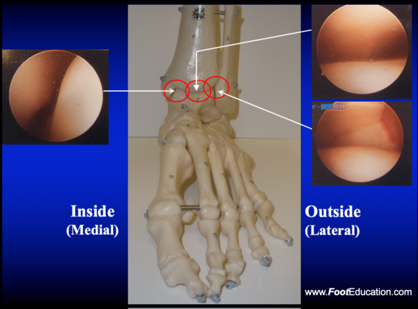 Ankle arthroscopy three common views -Normal ankle