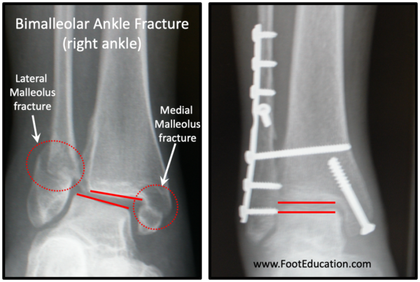 Bimalleolar ankle fracture without and with fixation