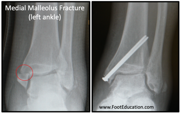 Medial malleolus ankle fracture with fixation