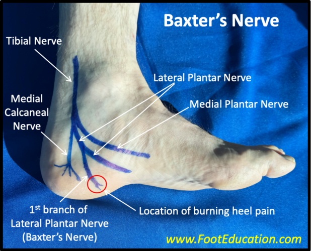 Baxter's Nerve First branch of the lateral plantar nerve. Compression of this nerve creates heel pain from calcaneal neuritis.
