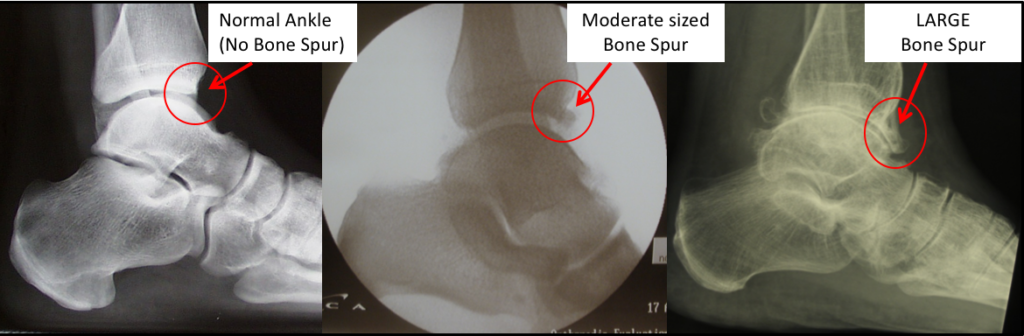 Lateral ankle x-rays showing anterior ankle bone spurs or ankle osteophytes