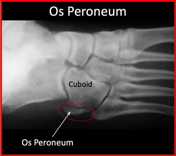 X-ray of an os peroneum with degenerative changes