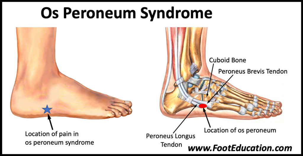 Os Peroneum Syndrome location of pain