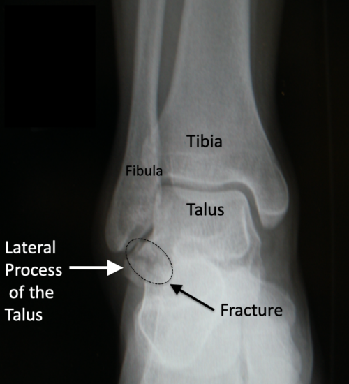 The Lateral Talar Process Fracture -The Snowboarder's Fracture ...