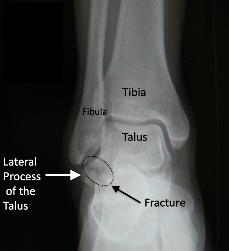Snowboarders Fracture aka lateral talar process fracture