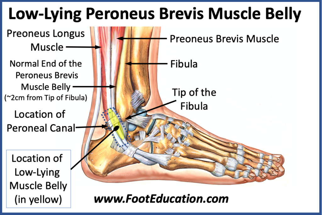Low lying peroneus brevis muscle belly