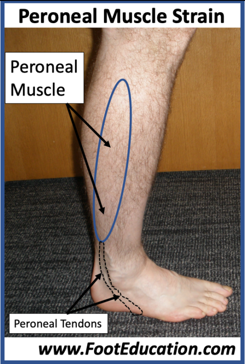 Peroneal Muscle Strain - FootEducation