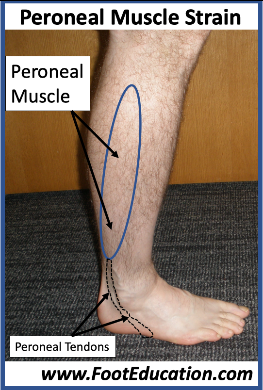 Peroneal Muscle Strain -Location of Peroneal Muscles