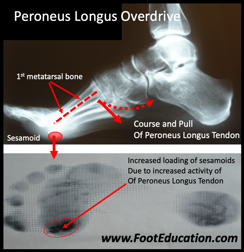 Peroneus Longus Overdrive