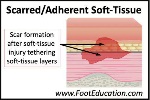 Scarred Adherent Soft-Tissue