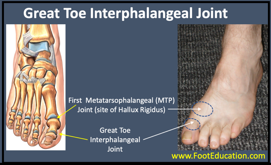 Great toe IP joint