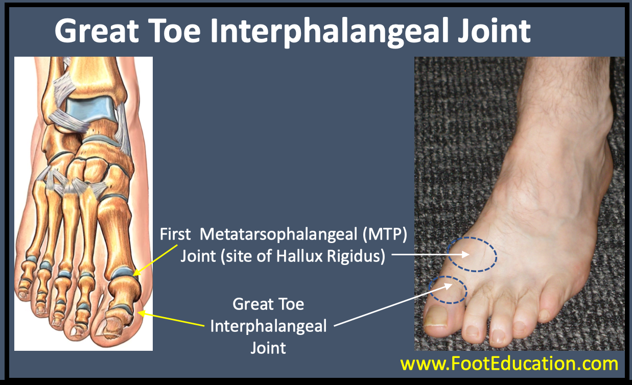 Great Toe Interphalangeal Joint Arthritis - FootEducation