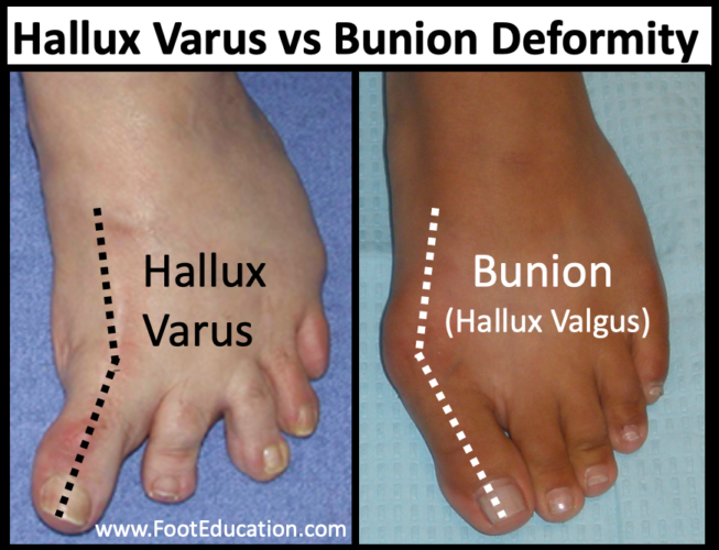 Hallux Varus - FootEducation