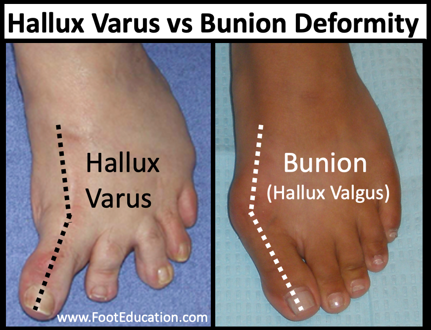 Hallux Varus deformity compared to a bunion hallux valgus deformity