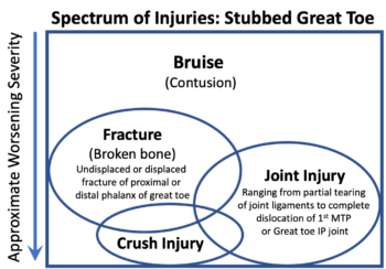 Stubbed Great Toe - FootEducation