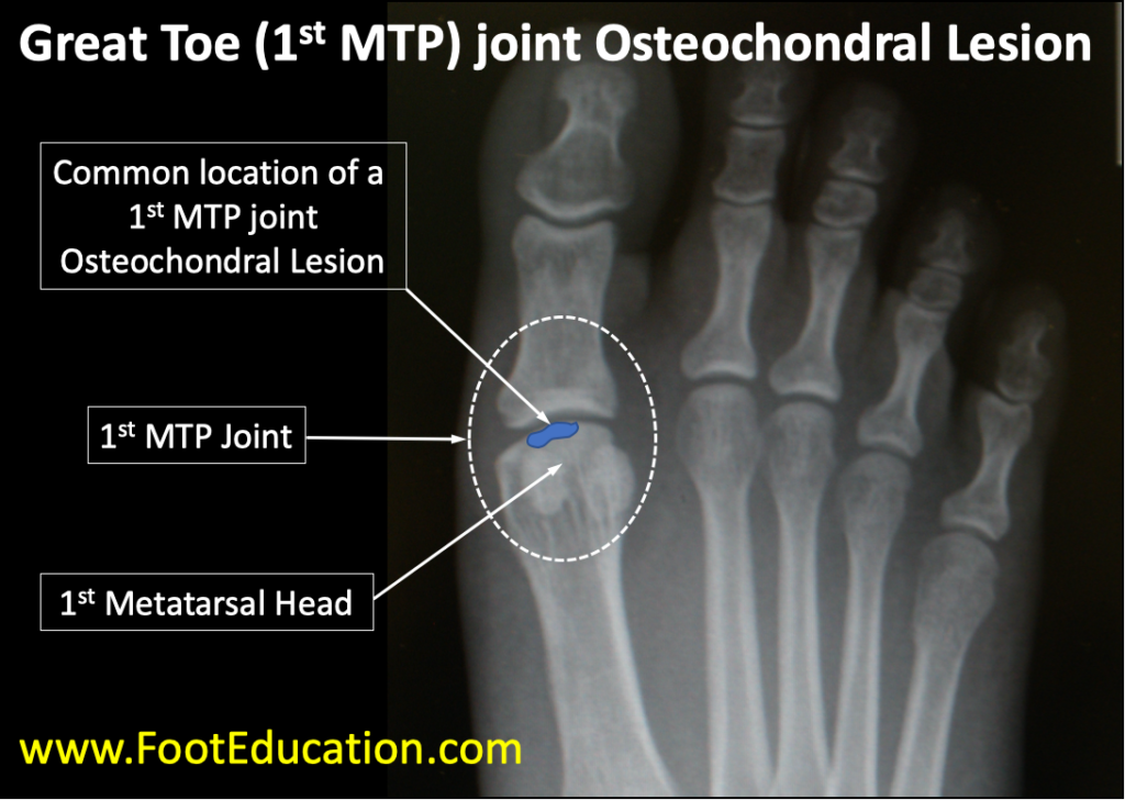 Diagram of a Great Toe 1st MTP joint osteochondral lesion