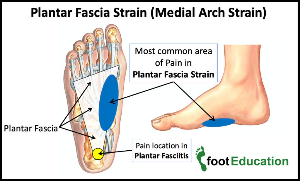 Plantar Fascia Strain Location of Pain