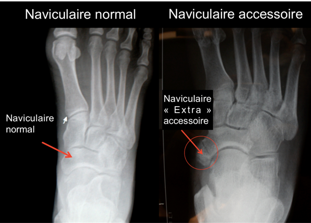 Naviculaire normal comparé à un naviculaire « accessoire »