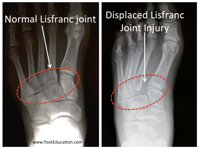 Fracture de l’articulation Lisfranc