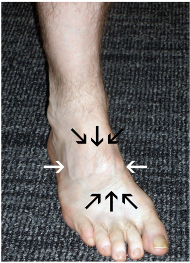 Localisation de la douleur en blessure de l’articulation de Lisfranc