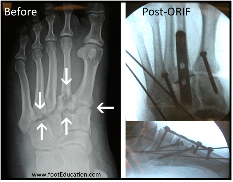 Traitement opératoire d’une blessure de Lisfranc