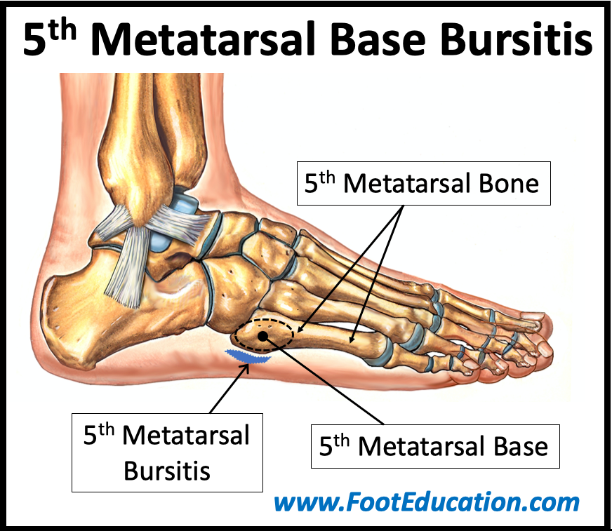 5th Metatarsal Base Bursitis