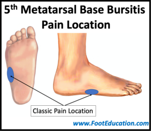 Fifth Metatarsal Base Bursitis - FootEducation