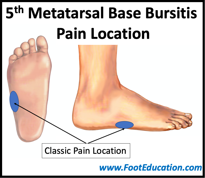 5th Metatarsal Base Bursitis -Pain Location