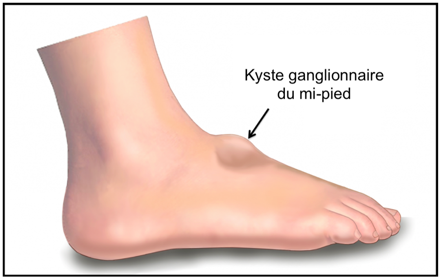 Kystes Ganglionnaires du Mi-Pied