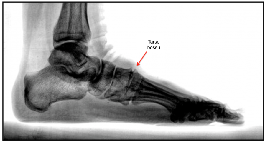 Radiographie du pied démontrant un tarse bossu (ostéophyte du mi-pied)