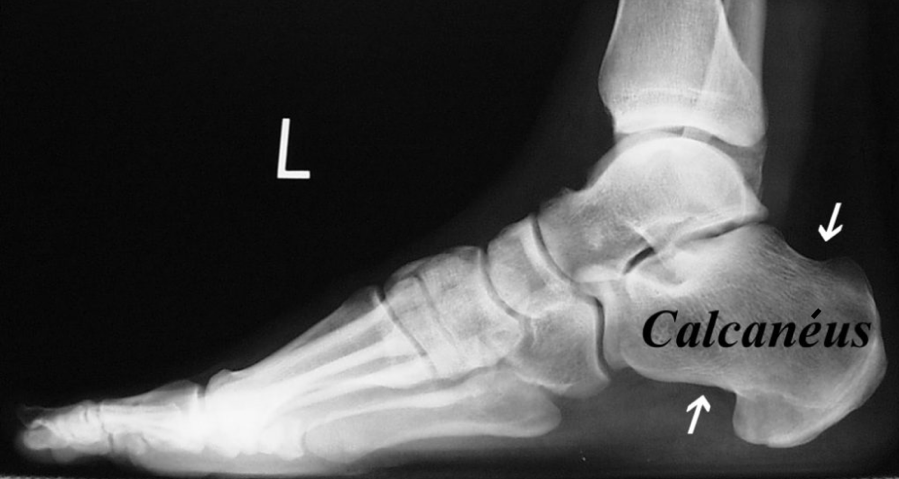 Radiographie du pied démontrant un calcanéus normal d’une vue latérale