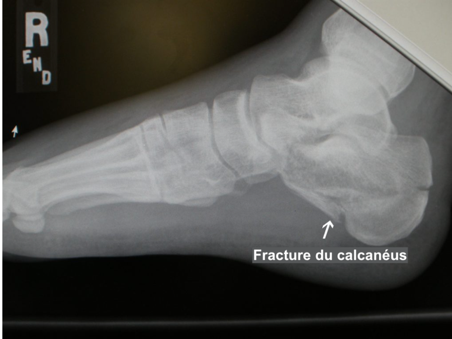 Radiographie d’une fracture du calcanéus