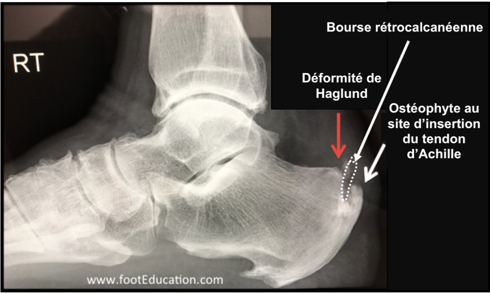 Radiographie démontrant la déformation de Haglund (flèche rouge)